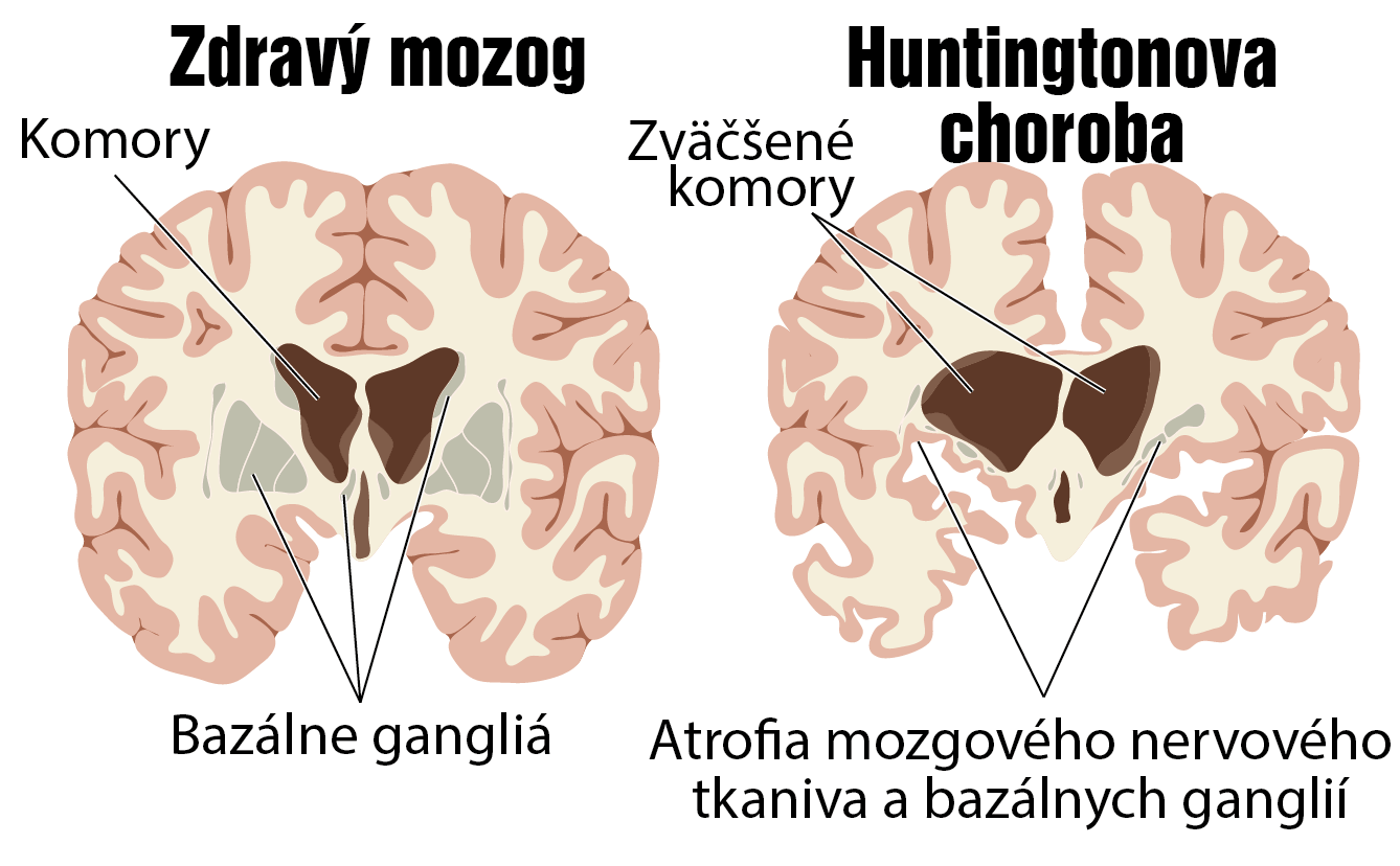 huntingtonova-choroba-pr-znaky-pr-iny-a-lie-ba